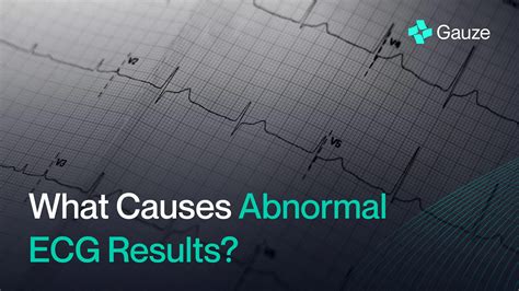 abnormal ekg results|Abnormal EKG: Results, causes, and treatment.